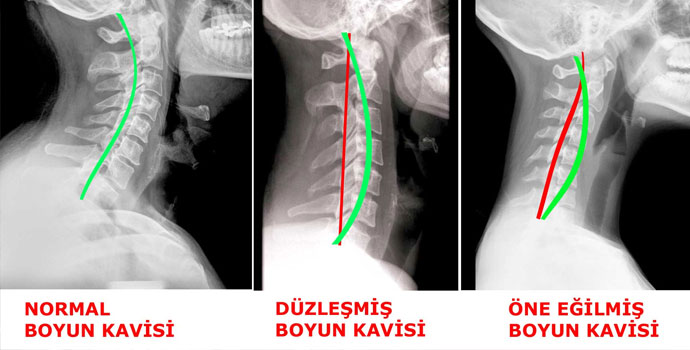 BOYUN DÜZLEŞMESİ